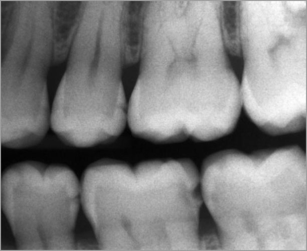 Röntgenbild - Zähne mit Karies